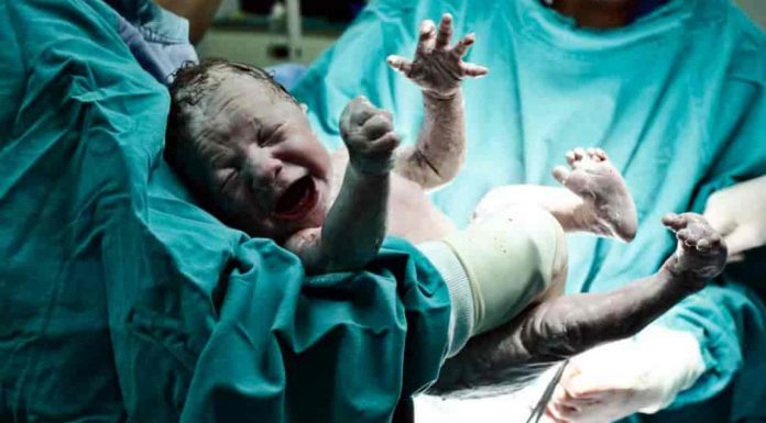 Persalinan Caesar dan Syarat Diperbolehkannya Caesar