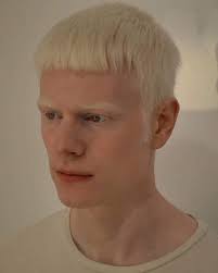 Perbedaan albino dan bule