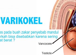Apa Itu Varikokel? Berikut Ini Penjelasannya apa itu varikokel