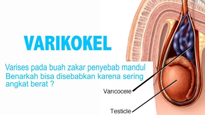 apa-itu-varikokel apa itu varikokel